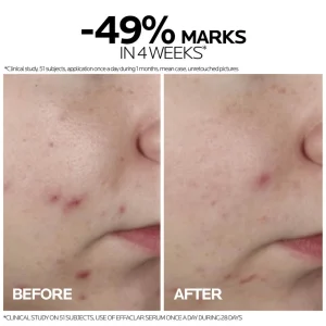 لاروش بوزيه إيفاكلار سيروم لحب الشباب 30 مل La Roche-Posay Effaclar Ultra Concentrated Serum 30ml